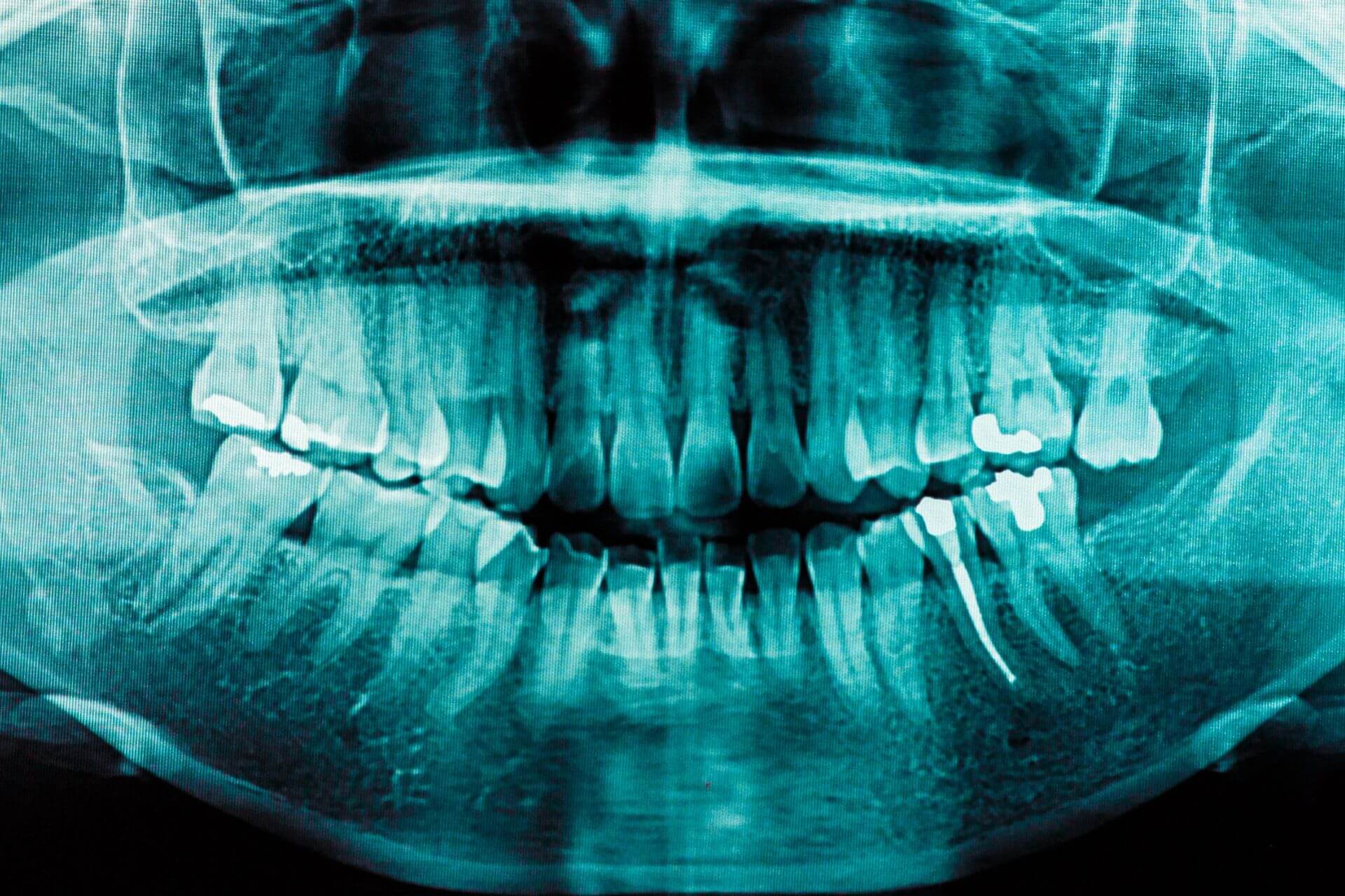 Welche Zahnfüllungen gibt es?